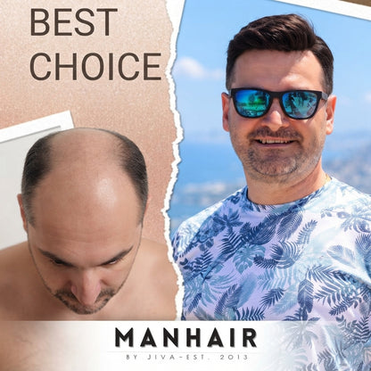 Serviciu montare calote barbati Top Hair System peruci partiale de barbati sau calote